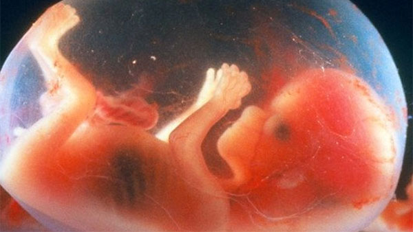 FIF Fetus in Fetus Foetus